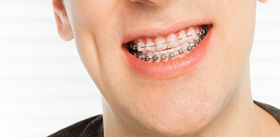 Damon Braces Vs. Traditional Braces: Which One Is Right For You?