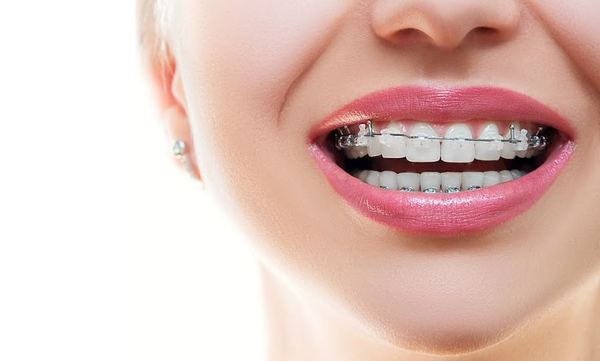 What Happens To Your Teeth When You Get Braces?